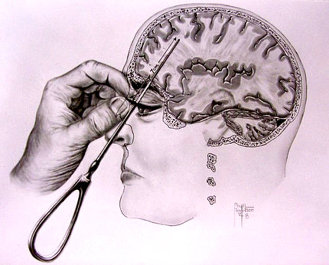 Illustration of 'icepick' lobotomy, from Dr. Walter Freenan II's 'Psychosurgery in the Treatment of Mental Disorders and Intractable Pain.' (1950)